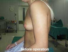 plastic-surgery-breast-augmentation 